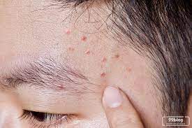8 Cara Mengatasi Jerawat Pasir Dengan Bahan Alami Efektif