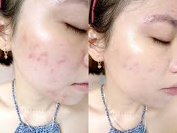 Laser bisa dimanfaatkan untuk meringankan kemerahan di sekitar lesi jerawat yang sudah sembuh. Cara Menghilangkan Bekas Jerawat Dengan Cepat Dan Mudah Halaman All Kompasiana Com