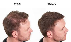 Pat to merge the fibres and using two shades together will in need of a pick me up? Nanogen Keratinske Fibre 15g I 30g Svijet Kose