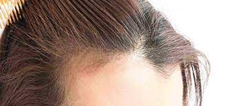 È risaputo che la perdita di capelli può essere dovuta sia a fattori come stress, alimentazione o stile di vita insano, sia a predisposizione genetici ed . Diradamento Capelli Cause Rimedi Soluzioni