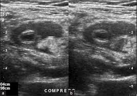 Pin On Appedicitis Omental Infarction