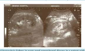 Renal disease is a relatively common complication in patients with human immunodeficiency virus (hiv) disease. Pdf Sonographic Findings In Renal Parenchymal Diseases At Sudanese Semantic Scholar