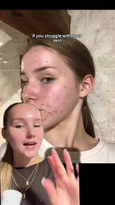 Product mentioned: @Dr Sam’s Skincare Flawless Nightly Serum (aka the  perfect retinoid for beginners), code LIFEWITHMILS always gets you 10% off  Dr Sam's ad #skincare #skinbarrier #Skintok #skincare ...