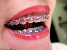 To Braces And Beyond Pink Braces Dental Braces Teeth Braces