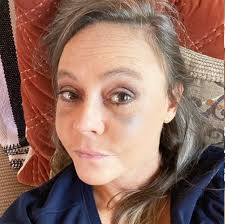 What are the types of thyroid cancer? What It S Like To Have Graves And Thyroid Eye Disease With Photos