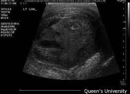 It is used for testicular torsion, and problems with blood flow in the testis. Face In Tumor Testicular Growth Shocks Doctors After Ultrasound News Khq Com
