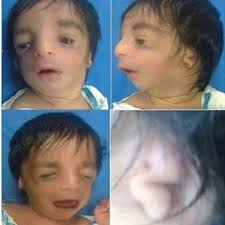 It is named for judith hall and philip pallister. A Boy With Pallister Hall Syndrome Who Had Imperforate Anus At Birth Download Scientific Diagram