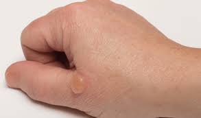 The pictures have now been shared as a warning to others to avoid using their own home remedies to help people with more serious burns, or burns that were larger than the palm of their hand or on if it's a first degree burn, can apply aloe vera. Burns Iscn