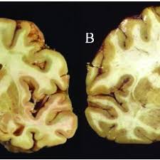 In what ways might einstein's brain biology have been different from average? Coronal Slices Of Advanced Cte A Compared To A Normal Brain B Download Scientific Diagram