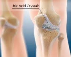 Image result for gout symptoms knee