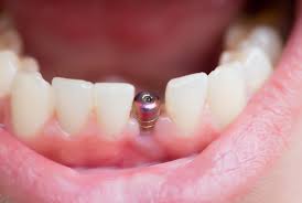 Maybe you would like to learn more about one of these? Pakai Retainer Dan Gigi Palsu