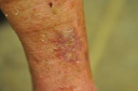 Image result for Pyoderma Gangrenosum
