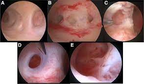 Symptoms And Classification Of Uterine Adenomyosis Including The Place Of Hysteroscopy In Diagnosis Fertility And Sterility