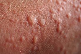 Symptoms that always occur with allergic contact dermatitis of the armpit: Bumps On Skin Skin Mysteries Explained The Healthy