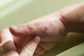 Image result for Skin Infection