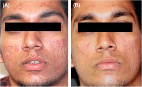 The 26-year-old man treated with 3 sessions of Intensif microneedling...