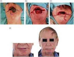 When the commissure is involved, both the karapandzic and estlander flaps can be used. References In Reconstruction Of The Lower Lip Using Bilateral Commissurotomy And Advancement Of Skin Muscle And Mucosal Flaps British Journal Of Oral And Maxillofacial Surgery