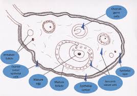 The ovaries are the female reproductive organs in which egg cells are produced. Natural History Of Ovarian Cancer Ecancer