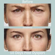 There's some mild confusion about how turnitin works so we're taking the time to discuss it as well. Dysport Cosmetic Edmonton Wrinkle Smile Line Relaxer Regina
