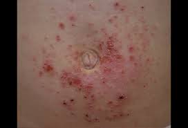 Nickel Contact Dermatitis Picture Image On Medicinenet Com