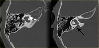 The inner ear arises from the otic placode, which is a thickening of the surface neuroectoderm located between the first branchial groove and the hindbrain. The Radiology Assistant Pathology