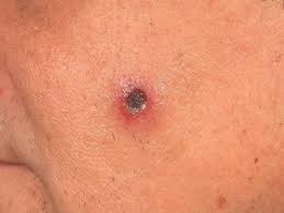 Image result for Deep Folliculitis
