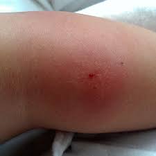 Bug Bite Black And Blue Ring What Bit Me Identifying Different Bug Bites Valley Pest Solutions