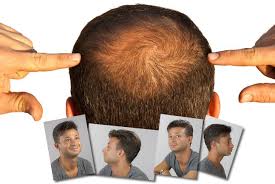 Am besten sucht man einen spezialisten auf, der die ursachen des haarausfalls eruiert. Frisur Bei Haarausfall Haarausfall Stoppen So Beugst Du Einer Glatze Vor 2020 03 08