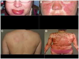 Systemic lupus erythematosus (sle) is a chronic inflammatory disease that has protean manifestations and follows a relapsing and remitting course. Differential Diagnoses In Lupus Sle Binding Tissue Diseases Nobindeveasic Diseases No