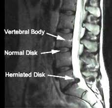 Ini disebabkab oleh gel antara tulang yang berfungsi menyerap tekanan telah bocor seterusnya mengakibatkan alihan. Apakah Itu Slipped Disc D Sakinah