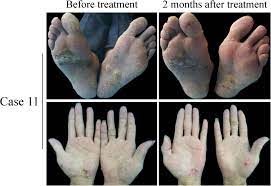Cut off one wart, and two grow in its place. Successful Clearance Of Extensive Recalcitrant Cutaneous Warts By Acitretin Monotherapy A Case Series Study Zhang 2020 Dermatologic Therapy Wiley Online Library