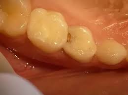 How long does it take to fill a cavity between teeth. What Might Cause A Cavity In Between Teeth Quora
