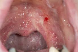 Oral thrush adalah suatu kondisi di mana jamur candida albicans terakumulasi pada lapisan mulut, yang juga dapat disebut dengan candidiasis. Oral Thrush Mouth Thrush Nhs