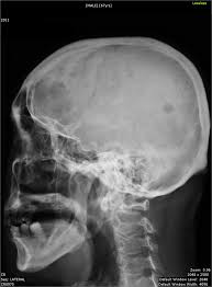 Multiple myeloma is often found by chance, when looking for the cause of a high esr or anaemia. Multiple Myeloma Something About Radiology Just For Sharing