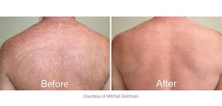 She tells you what will be best for you and in the end you look beautiful. Laser Hair Removal Permanent Hair Reduction Chicago