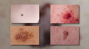 Here's what skin cancer actually looks like. 3 Ways To Spot Early Signs Of Skin Cancer Wikihow