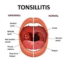Black And White Spots On Tonsils A Bacterial Infection Always Causes This Illness And Unlike The Typical Sore Throat You Will Li In 2020 Strep Throat Remedies Swollen Uvula Healthy Lifestyle Changes