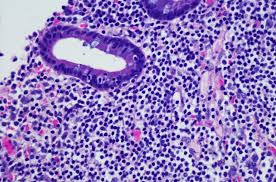 Image result for Lymphoma