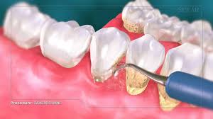 Saya ms.belinda binti maikal 2 years ago malam jam berapa tutup cabut gigi punya.hari berapa ke hari berapa? Pengalaman Scaling Dan Polishing Gigi Di Klinik Pergigian Dentessence Mawardi Yunus