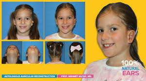 A well-made new ear is indistinguishable from a normal ear. We make  “bespoke” new ears with each patient's own tissues. Look at this 8-year-old  charismatic young man who was born with unilateral