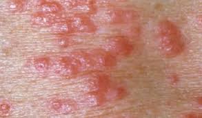 Image result for Scabies