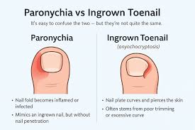 Image result for Paronychia feet