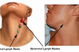 Kanker getah bening, atau biasa disebut limfoma, adalah kanker yang muncul pertama kali pada kelenjar getah bening. Muncul Benjolan Di Leher Kamu Kenali Tanda Pembengkakan Kelenjar Getah Bening Semua Halaman Hai