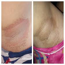 Image result for Erythrasma