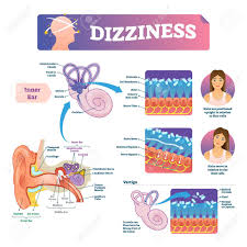 Start studying inner ear model. Dizziness Vector Illustration Labeled Medical Scheme With Inner Royalty Free Cliparts Vectors And Stock Illustration Image 123463617