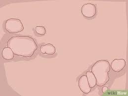 Human papillomaviruses (hpv) are extremely common viruses. ÙƒÙŠÙÙŠØ© ØªØ´Ø®ÙŠØµ ÙˆØ¹Ù„Ø§Ø¬ ÙÙŠØ±ÙˆØ³ Ø§Ù„ÙˆØ±Ù… Ø§Ù„Ø­Ù„ÙŠÙ…ÙŠ ÙÙŠ Ø§Ù„Ø±Ø¬Ø§Ù„ 11 Ø®Ø·ÙˆØ©