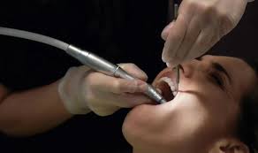 İltihaplı Diş Çekilir Mi? Apseli Diş Nasıl Tedavi Edilir?