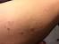 Lots Of Ingrown Hairs On Legs