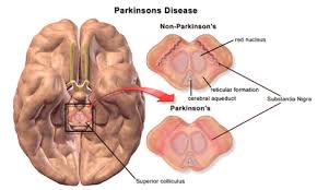 There is strong evidence that it first affects the dorsal motor nucleus of the vagus nerve and the olfactory bulbs and nucleus, then the locus coeruleus, and eventually the substantia nigra. Pathophysiology Of Parkinson S Disease Wikipedia