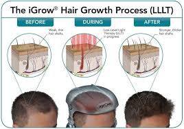 Reversing the problem of hair loss, hair thinning, and a receding hairline can be easily done using the illumiflow laser cap. Noreen Clinic Introducing The New Hair Laser Treatment Igrow Hair Growth Utilizing Both Red Laser And Led Light Diodes Igrow S Proprietary Hair Rejuvenation Technology Is Extremely Effective Low Level Laser